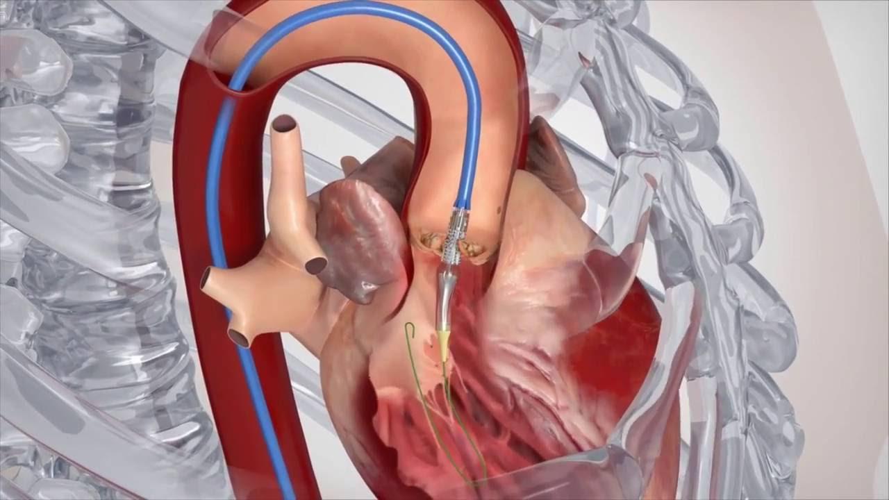 Factors Affecting Recovery from Heart Valve Surgery video screenshot